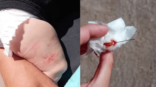 Enfermeiro esquece agulha na perna de bebê após aplicação de vacinas