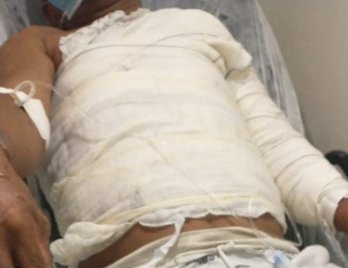 Homem sofre queimadura em 50% do corpo após acidente doméstico