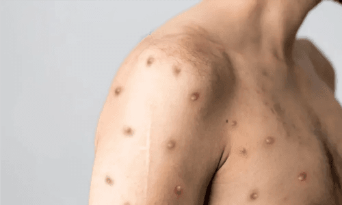 Brasil confirma primeiro caso da nova cepa do vírus Mpox