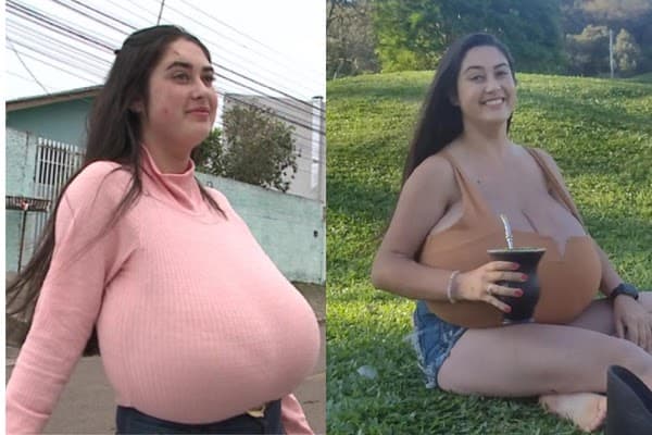 Gigantomastia: Doença faz seios de jovem pesarem 10 quilos no Paraná