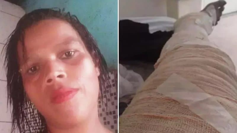Sem dinheiro para gás, jovem morre após queimar 85% do corpo com álcool