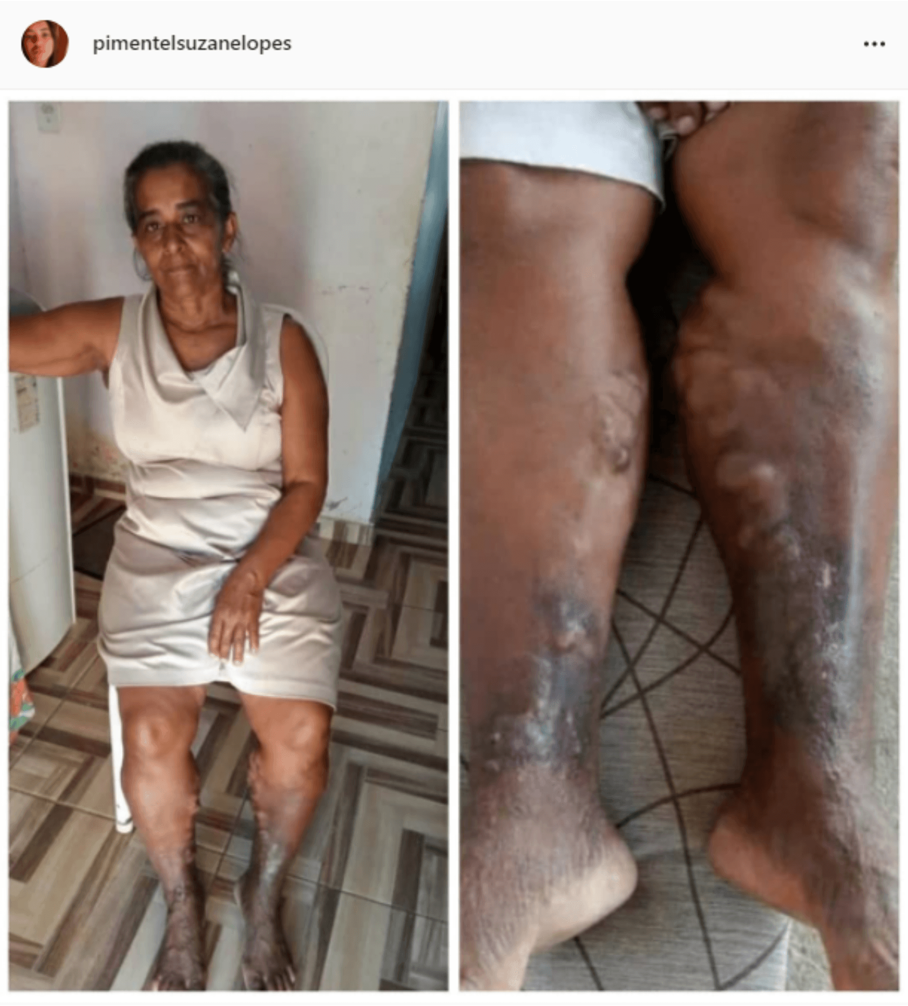 Moradora de Ibirataia faz apelo em busca de apoio para cirurgia vascular nas pernas