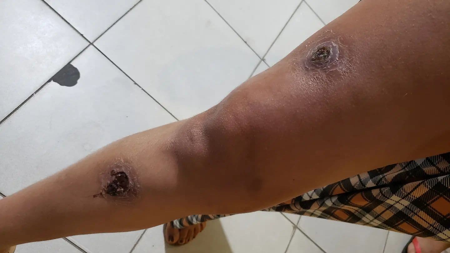 Casal infectado com calazar pede atenção da Vigilância na Bahia