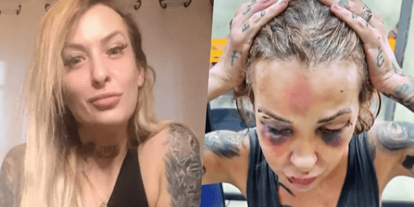 Jornalista é agredida pelo namorado com cassetete e soco inglês