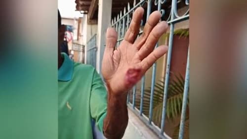 Ipiaú: Mulher arranca pedaço da mão de idoso com mordida após invadir residência da vítima