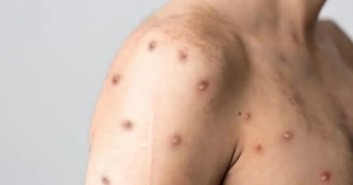 Brasil ultrapassa marca de mil casos de mpox em 2024; Bahia é o 3º estado com mais notificações da doença