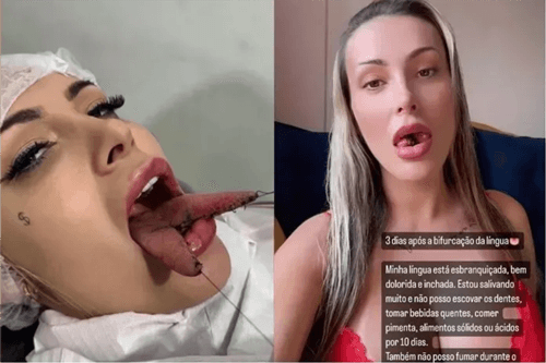 Andressa Urach agita redes sociais ao compartilhar recuperação de cirurgia de bifurcação da língua