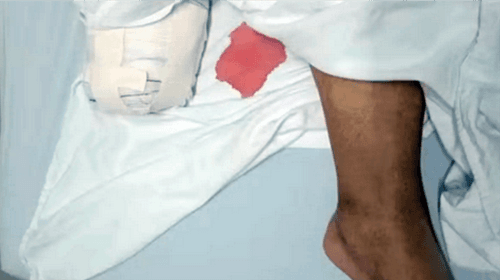 Pedreiro tem o pé amputado após infecção causada por brinco