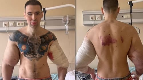 Influenciador 'Popeye Russo' é hospitalizado para remover bíceps artificiais