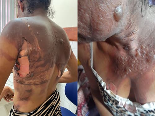 Mulher é queimada pelo companheiro com água fervente em Ipiaú