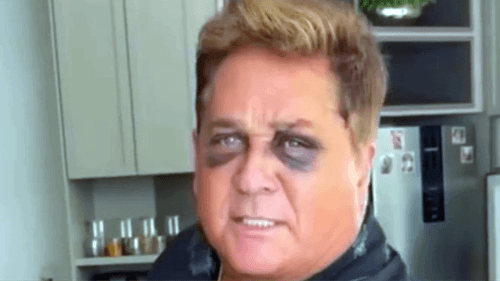 Leonardo revela motivo de queda que causou fratura no rosto durante pescaria