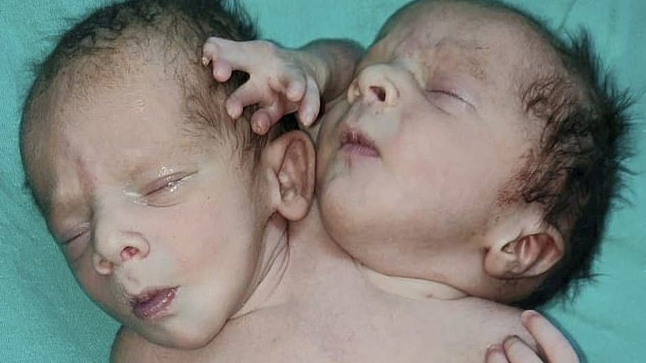 Bebê surpreende pais e médicos ao nascer com duas cabeças, três braços e dois corações