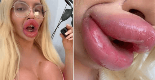 Influencer gasta quase R$ 1 milhão em estética e revela: “Não consigo fechar a boca”
