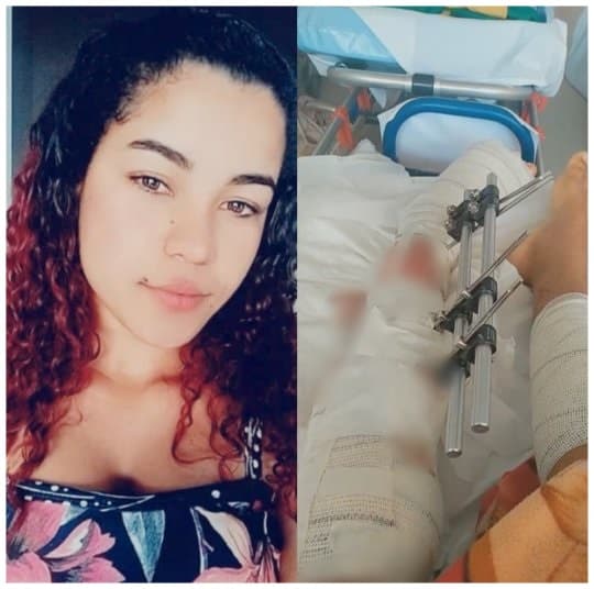 Mulher que foi atropelada e teve fratura exposta pede ajuda e orações