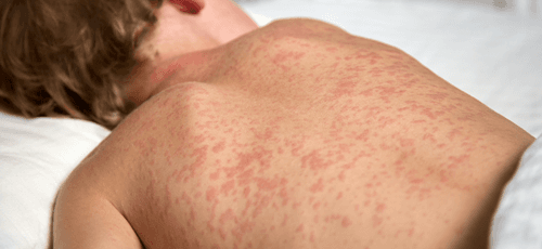 Casos de sarampo na Bolívia acendem alerta no Brasil