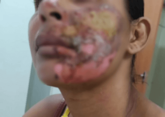 Homem é preso por jogar óleo quente no rosto da companheira em Itamaraju