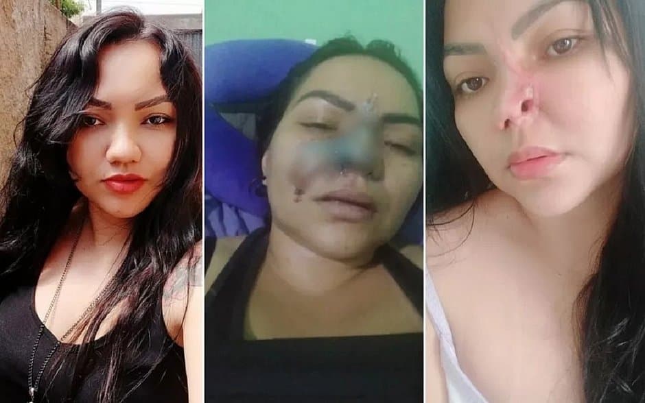 Mulher perde parte do nariz após cirurgia estética com dentista