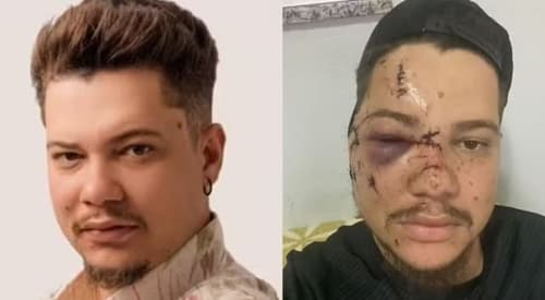 Cantor Sertanejo agredido em show fica com cicatriz permanente e acumula prejuízo de R$ 50 Mil