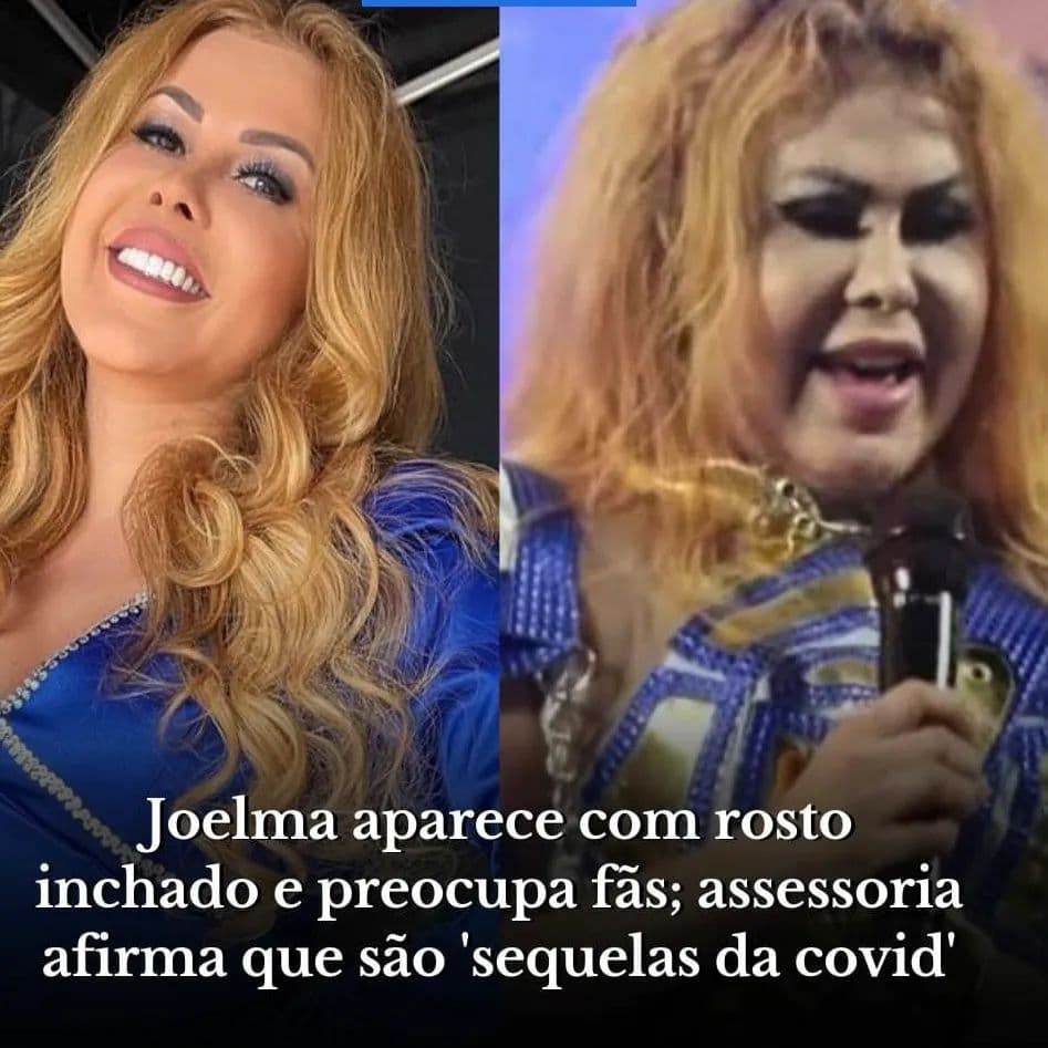 Inchaço no rosto de Joelma preocupa fãs; assessoria explica a causa