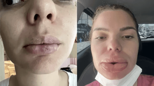 Mulher viraliza na web após divulgar resultado de preenchimento labial: "Tive necrose e quase morri"