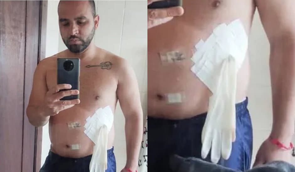 Homem recebe luva no lugar de bolsa de colostomia após cirurgia