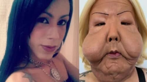 Juju do Pix inicia cirurgia para remover óleo mineral do rosto após danos desde 2017