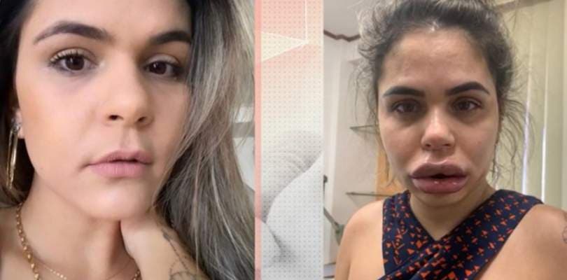 Dentista é acusada de deformar rosto de 18 pacientes com harmonizações faciais
