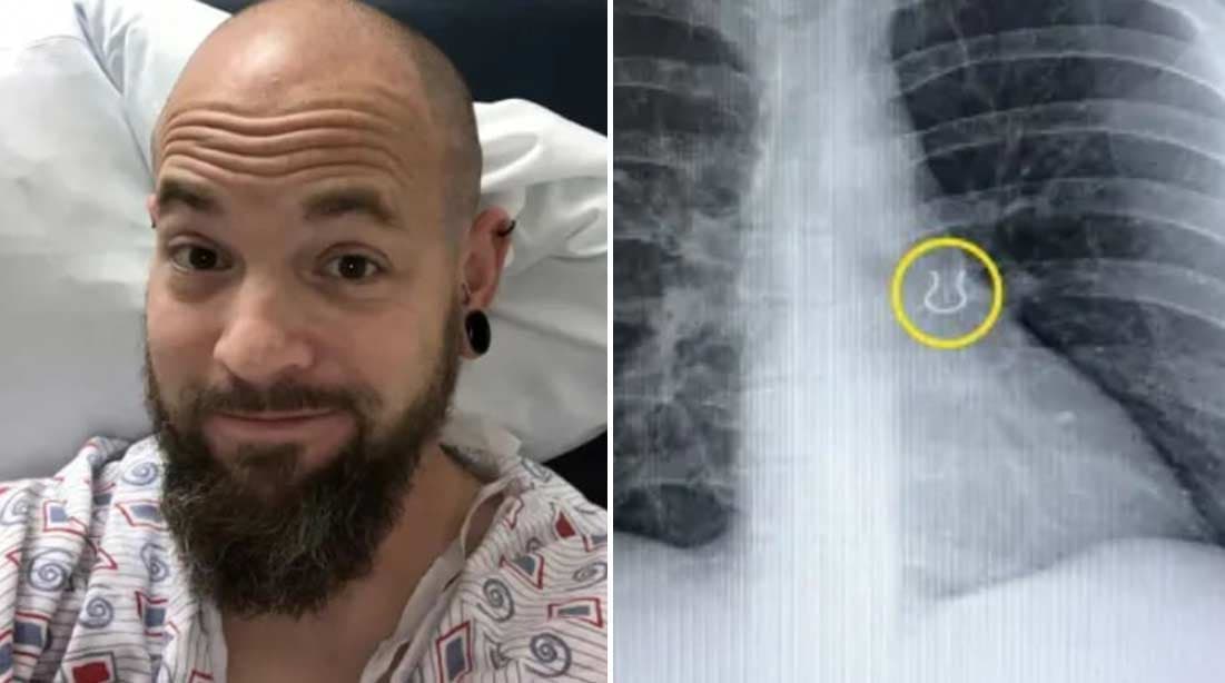 Piercing perdido há 5 anos é encontrado no pulmão de homem