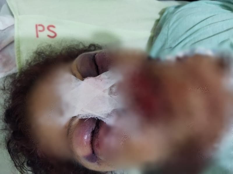 Mulher fica com rosto desfigurado após agressões de ex-companheiro na Bahia