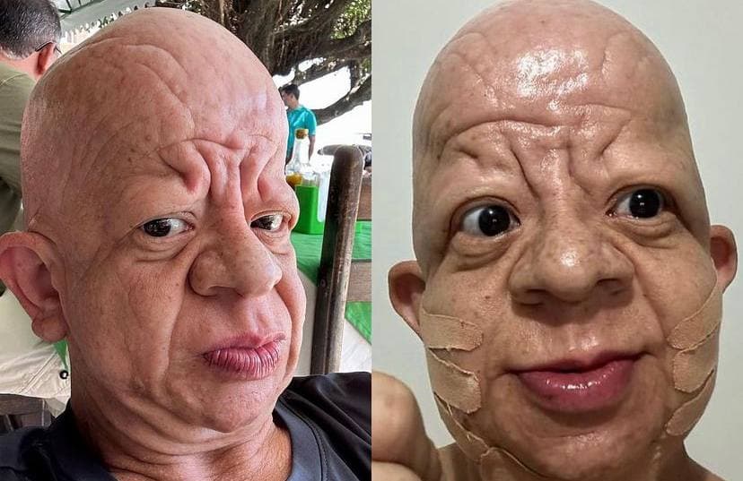 Influencer Bruno Diferente faz harmonização facial e surpreende
