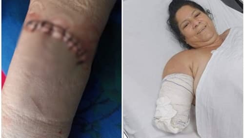 Itagibá: Mulher tem antebraço amputado após acidente com vidro; família acusa hospital local de negligência