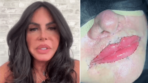 Gretchen reverte procedimento estético e retira PMMA dos lábios aos 66 anos