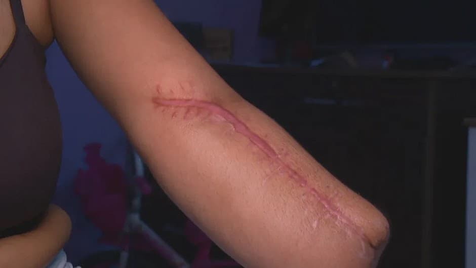 Mulher tem mão amputada após dar à luz em hospital do Rio