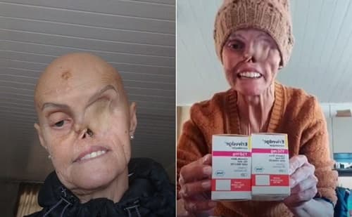 Dona Hilária vence 72 batalhas contra o Câncer com apoio e Ggenerosidade