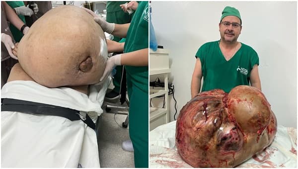 Cirurgião retira tumor maligno de 46kg da barriga de uma paciente