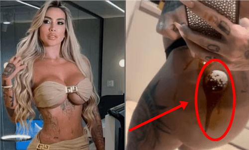Modelo Juju Ferrari expõe complicações após uso de hidrogel e alerta sobre riscos