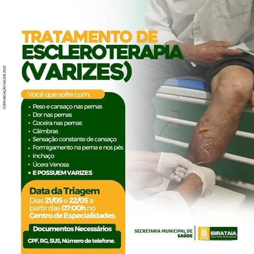Triagem para Tratamento de Varizes com Escleroterapia acontece em Ibirataia nos dias 21 e 22 de maio