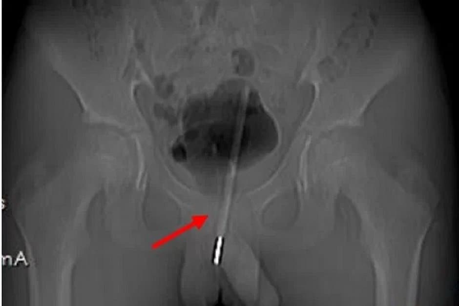 Adolescente é submetido a cirurgia após inserir termômetro no pênis