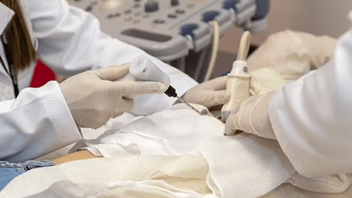 Nova técnica contra câncer de mama, que congela o tumor, atinge 100% de eficácia
