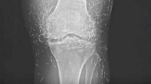 Fragmentos ocultos: radiografia revela causa inesperada de dor intensa no joelho