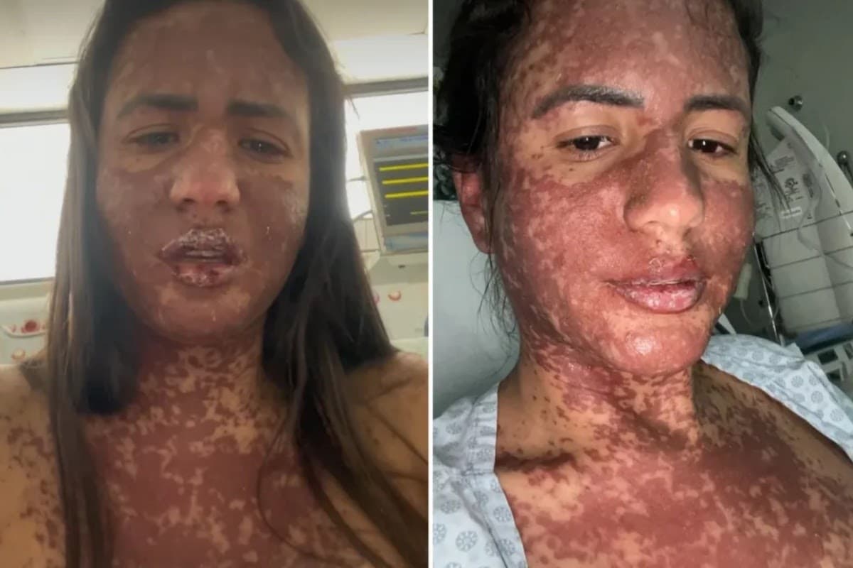 Mulher de Frank Aguiar relata ter tido doença rara que queima a pele