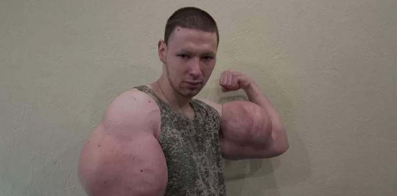 "Popeye russo" passa por cirurgias e corre risco de morrer