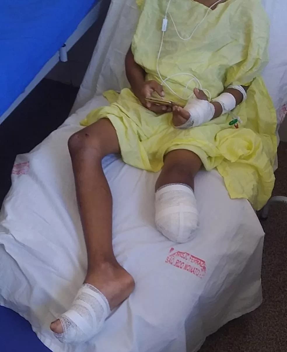 Menino de 9 anos tem perna amputada ao cair de ônibus escolar
