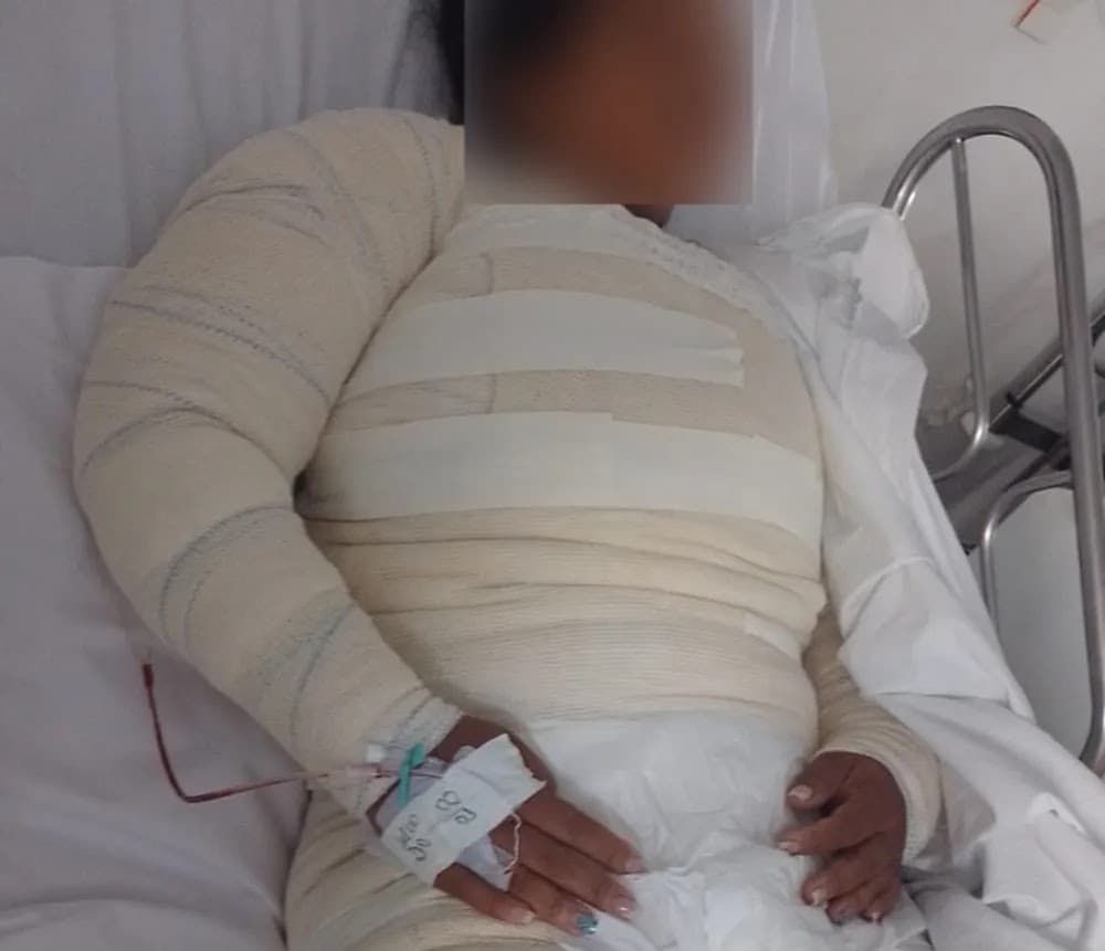 Mulher tem 50% do corpo queimado após ser atacada com água fervente na Bahia
