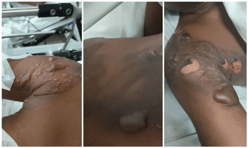 Mulher joga água quente no marido após descobrir mensagens com outra na Capital