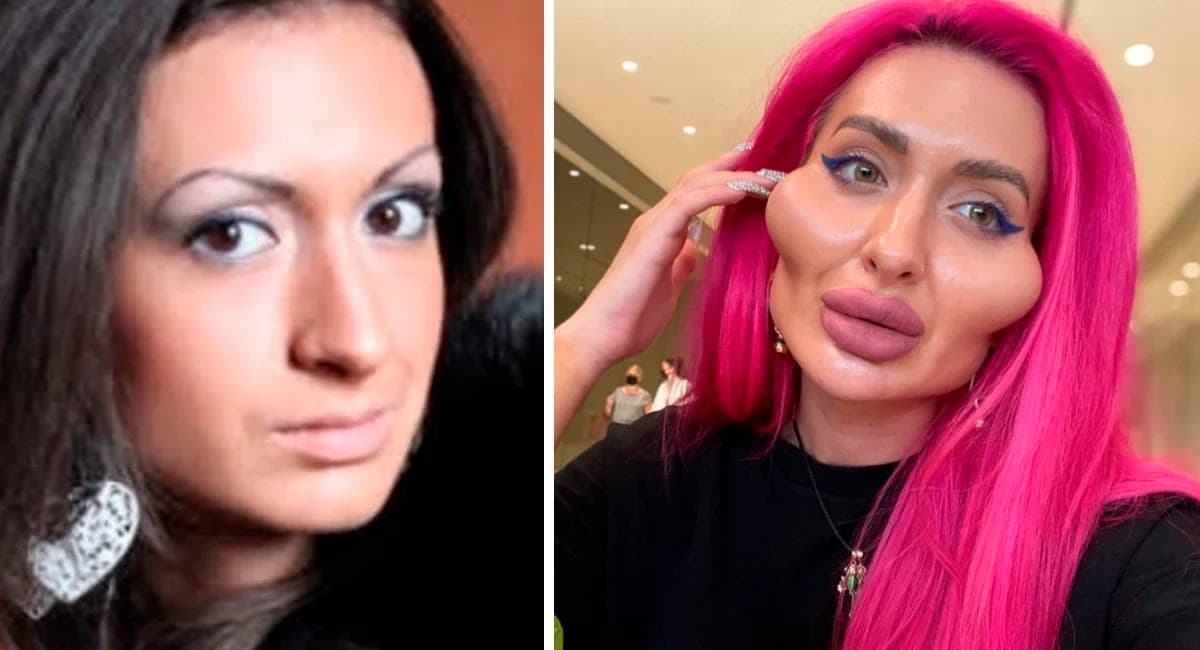 Mulher é criticada por gastar mais de R$ 11 mil em preenchimentos no rosto e diz: “Nunca vou parar”