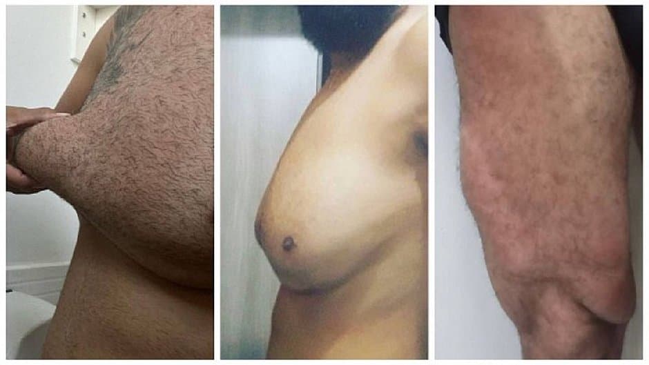 Homem fica com corpo deformado após injetar gel: 'Queria ganhar físico rápido'