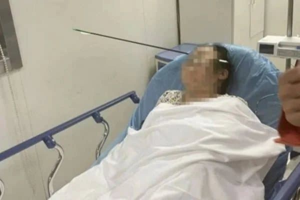 Mulher tem rosto atravessado por flecha de aço na China
