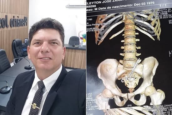 Médicos esquecem tesoura dentro do corpo de vereador após cirurgia