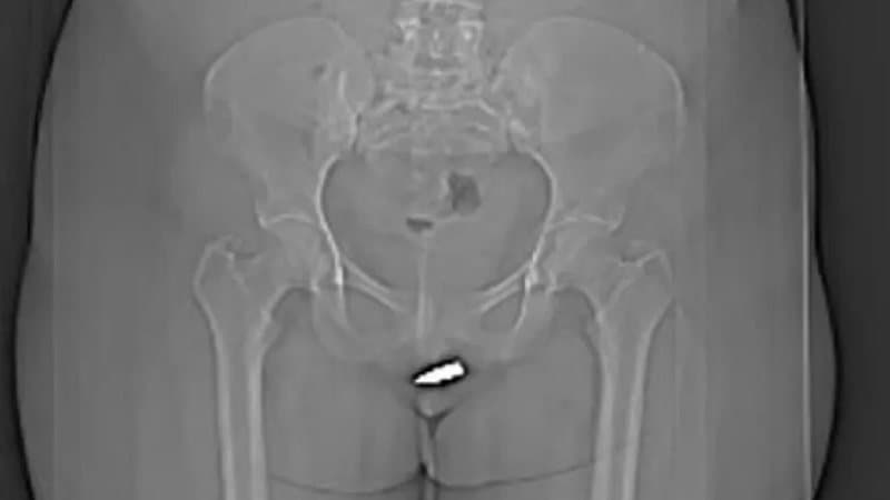 Mulher é baleada e passa por cirurgia após bala atingir seu clitóris